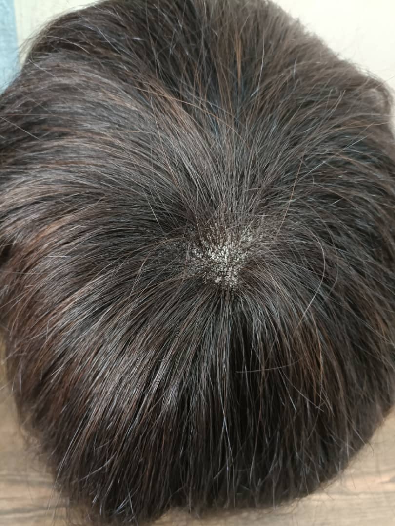 کلاه گیس مردانه طبیعی پروتز مو بالای سر مردانه (کد:8025)