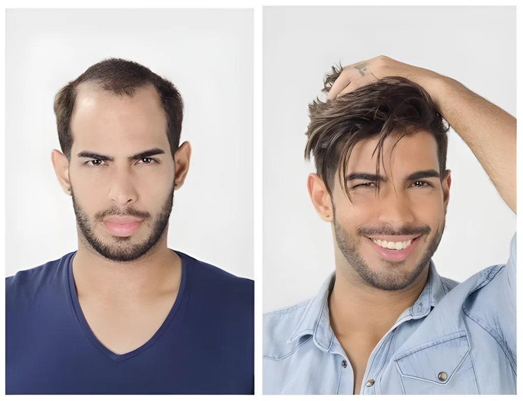پروتز مو بالا سر مردانه